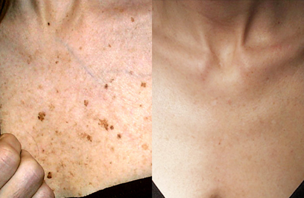 Age Spots Before & After